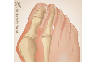 voet-hallux-valgus-anatomie
